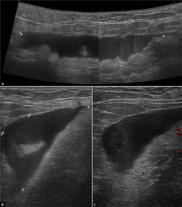 Hematoma ecografia tempo formacion 4.jpg